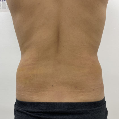 Liposculpture Before & After Patient #1396