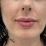 Lip Fillers Before & After Patient #1401