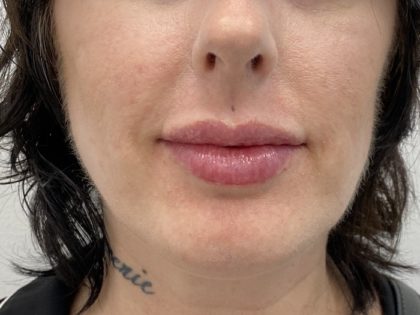 Lip Fillers Before & After Patient #1401