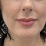 Lip Fillers Before & After Patient #1401