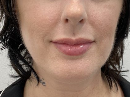 Lip Fillers Before & After Patient #1401