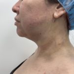 Liposculpture Before & After Patient #1404