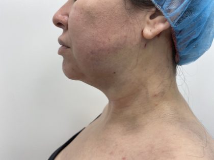 Liposculpture Before & After Patient #1404