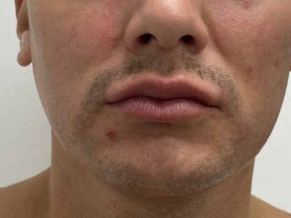Lip Fillers Before & After Patient #1407