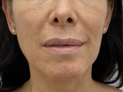 Lip Fillers Before & After Patient #1410