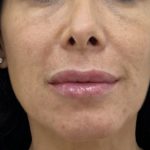 Lip Fillers Before & After Patient #1410