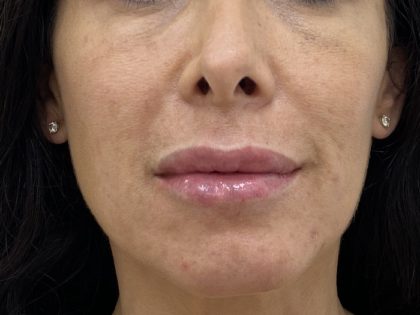 Lip Fillers Before & After Patient #1410