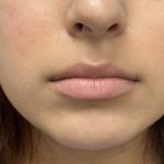 Lip Fillers Before & After Patient #1419