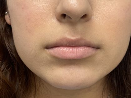 Lip Fillers Before & After Patient #1419