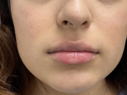 Lip Fillers Before & After Patient #1419