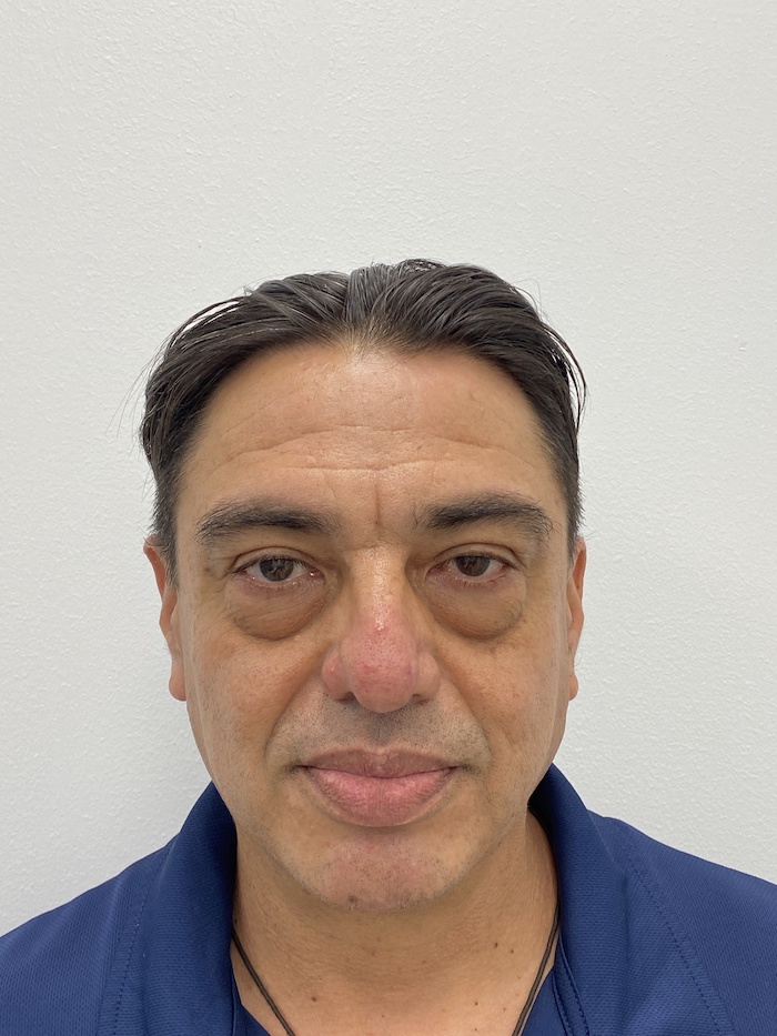 Blepharoplasty Before & After Patient #1422