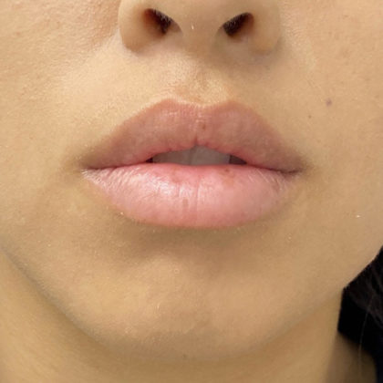 Lip Fillers Before & After Patient #1327