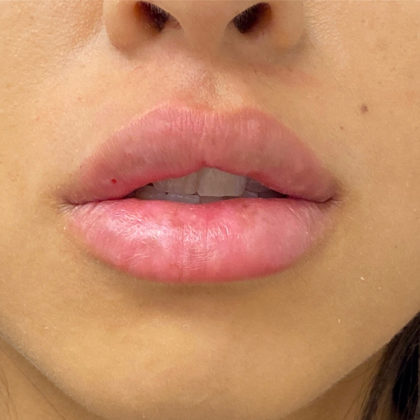 Lip Fillers Before & After Patient #1327