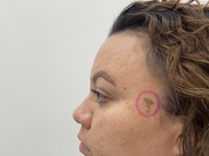 Mole Removal Before & After Patient #1425