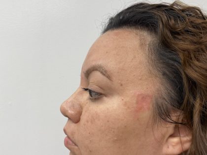 Mole Removal Before & After Patient #1425