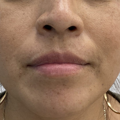 Lip Fillers Before & After Patient #1330