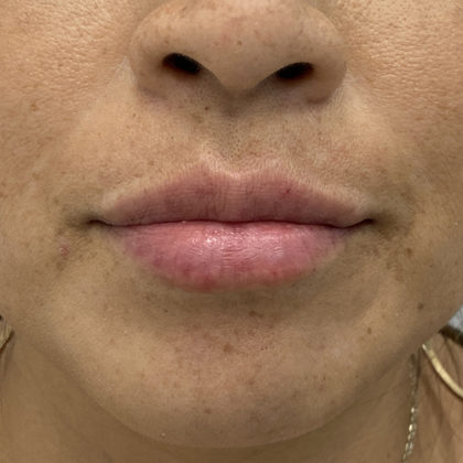 Lip Fillers Before & After Patient #1330