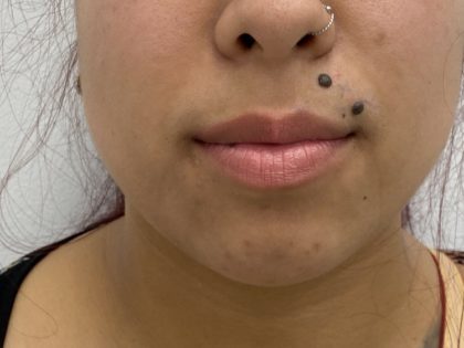 Mole Removal Before & After Patient #1340