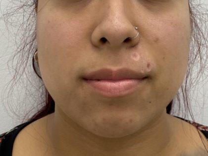 Mole Removal Before & After Patient #1340