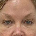 Under Eye Fillers Before & After Patient #1315