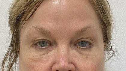 Under Eye Fillers Before & After Patient #1315