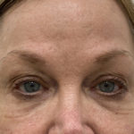 Under Eye Fillers Before & After Patient #1315