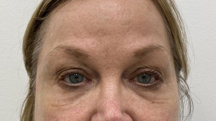 Under Eye Fillers Before & After Patient #1315