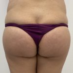 Brazilian Butt Lift Before & After Patient #1349