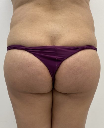 Brazilian Butt Lift Before & After Patient #1349