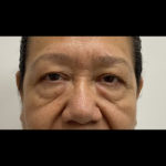 Blepharoplasty Before & After Patient #1306