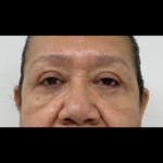 Blepharoplasty Before & After Patient #1306