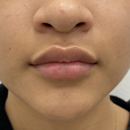 Lip Fillers Before & After Patient #1302