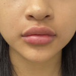 Lip Fillers Before & After Patient #1302