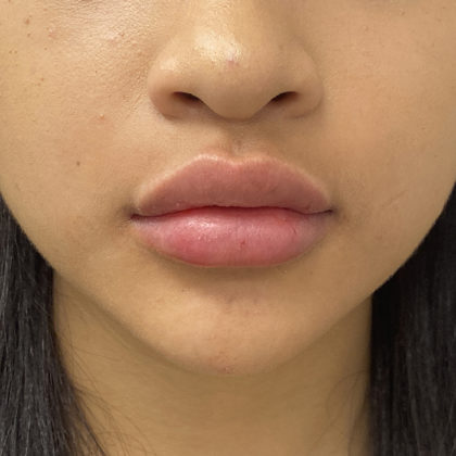 Lip Fillers Before & After Patient #1302