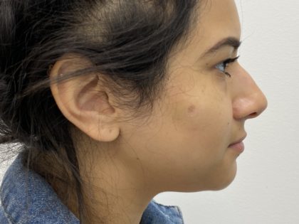 Mole Removal Before & After Patient #1535