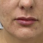 Lip Fillers Before & After Patient #1523