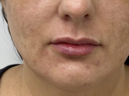 Lip Fillers Before & After Patient #1523