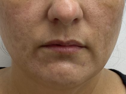 Lip Fillers Before & After Patient #1523