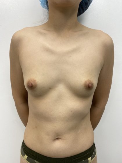 Breast Augmentation Before & After Patient #1502