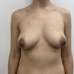 Breast Augmentation Before & After Patient #1490