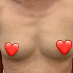 Breast Augmentation Before & After Patient #1458