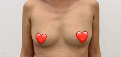 Breast Augmentation Before & After Patient #1458