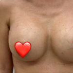 Breast Augmentation Before & After Patient #1458