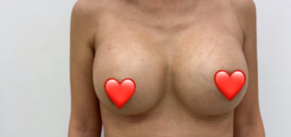 Breast Augmentation Before & After Patient #1458