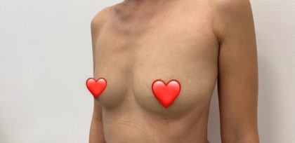 Breast Augmentation Before & After Patient #1458