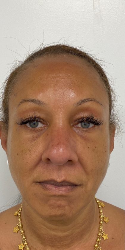 Facial Fillers Before & After Patient #1526