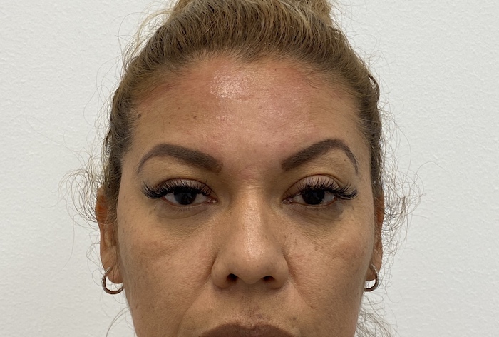 Facial Fillers Before & After Patient #1463