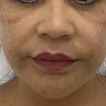 Facial Fillers Before & After Patient #1487