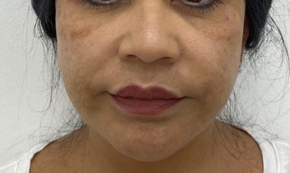 Facial Fillers Before & After Patient #1487