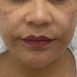 Facial Fillers Before & After Patient #1487
